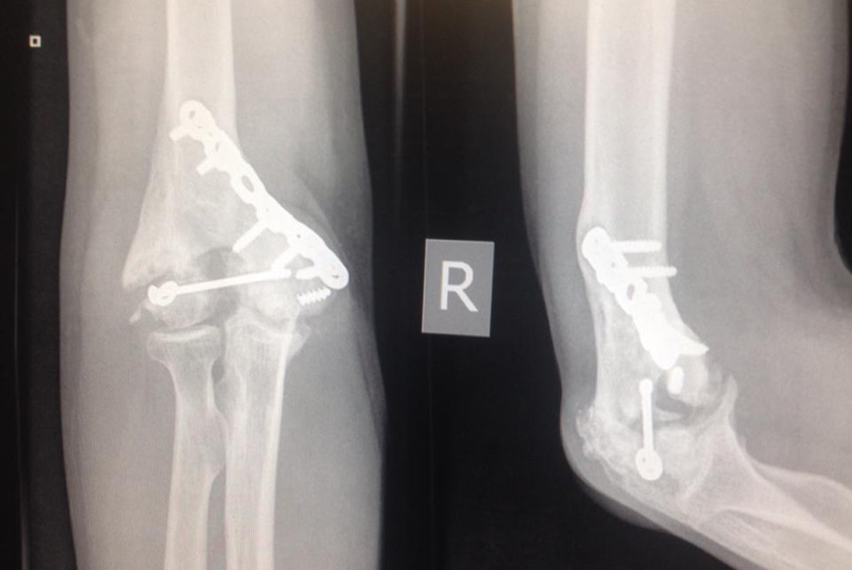 Back to surgery